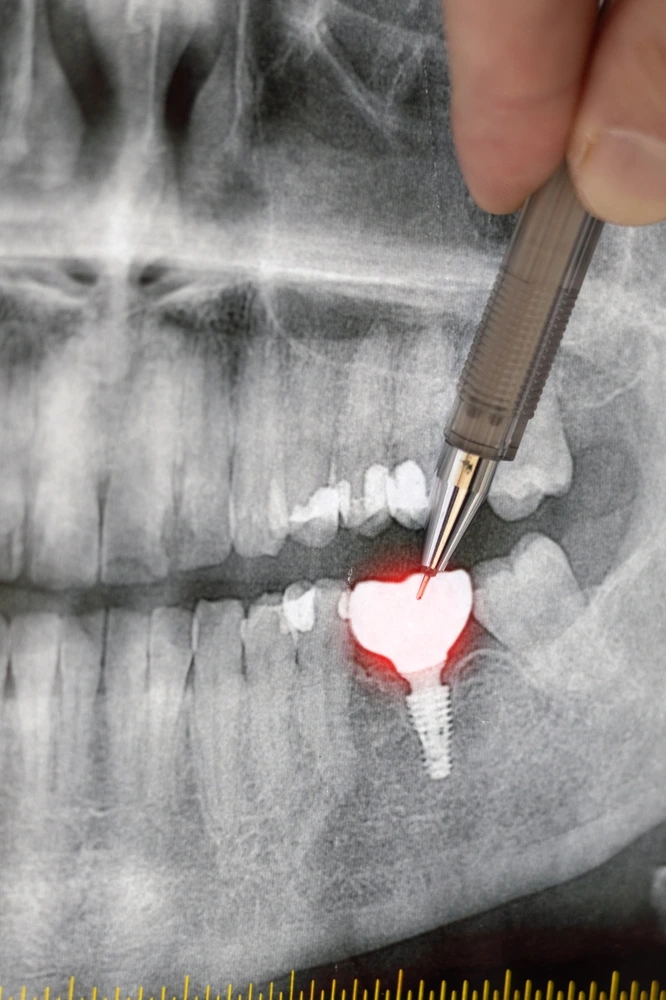 A dental X-ray showing a dental implant procedure performed at Clearly Dental Camden