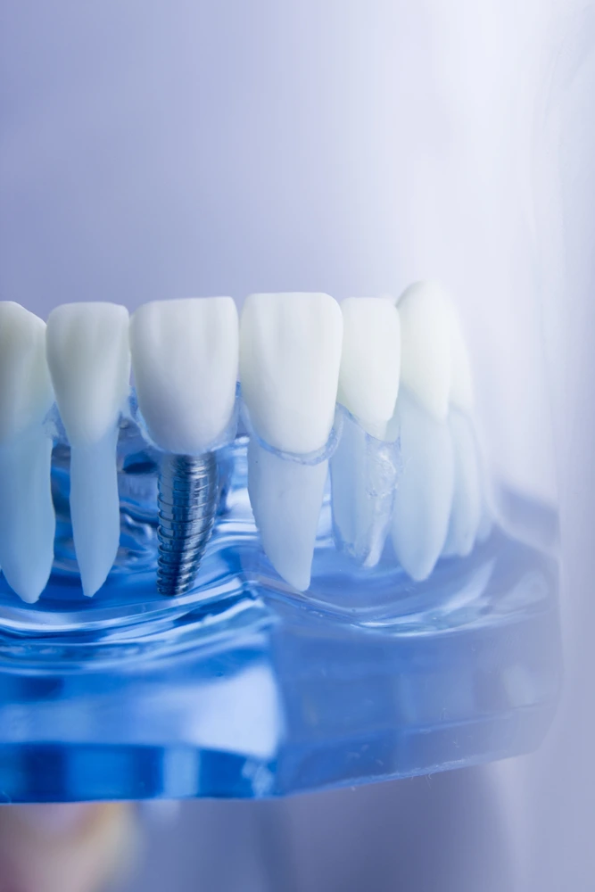 A dental implant model showcasing tooth replacement treatment at Clearly Dental Camden